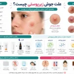 اینفوگرافیک علت جوش زیرپوستی، علائم، روش‌های درمان و راهکارهای پیشگیری از آکنه زیرپوستی